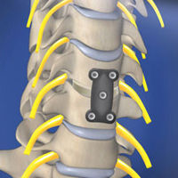 CERVICAL TREATMENT=Anterior Cervical Discectomy and Fusion (Intervertebral Spacer)