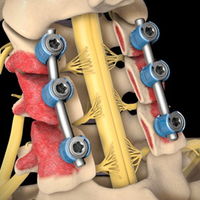 CERVICAL TREATMENT=Cervical Laminectomy with Fusion