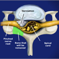 CERVICAL TREATMENT=Cervical Posterior Foraminitomy