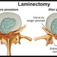 LUMBAR TREATMENT=Laminectomy