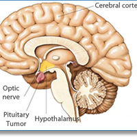 PITUITARY TUMORS=Pituitary Adenomas