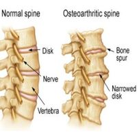 SPINAL DISORDERS=Arthritis - Rheumatoid Arthritis, Osteoarthritis and Spinal Arthritis