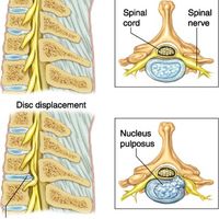 SPINAL DISORDERS=Myelopathy