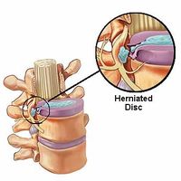SPINAL DISORDERS=Herniated or Ruptured Disc