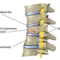 SPINAL DISORDERS=Spinal Compression Fractures