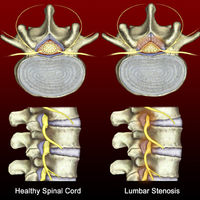 SPINAL DISORDERS=Spinal Stenosis