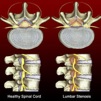 SPINAL DISORDERS=Spinal Stenosis SPINAL DISORDERS=Spinal Stenosis