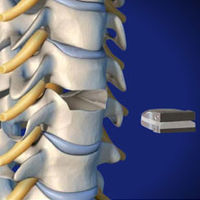 CERVICAL TREATMENT=Artificial Cervical Disc Replacement