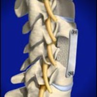 CERVICAL TREATMENT=Cervical Corpectomy