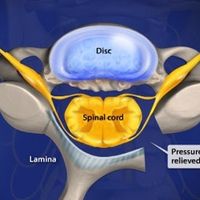 CERVICAL TREATMENT=Cervical Laminoplasty