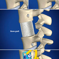 LUMBAR TREATMENT=Lumbar Corpectomy and Fusion