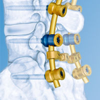 LUMBAR TREATMENT=Lumbar Pedicle Screw fixation