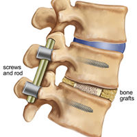 LUMBAR TREATMENT=Transforaminal Lumbar Interbody Fusion(TLIF)