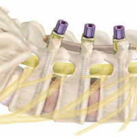 LUMBAR TREATMENT=Posterior Interbody fusion(PLIF)