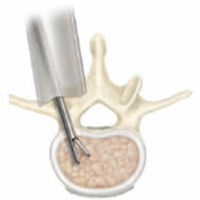 LUMBAR TREATMENT=Lumbar Microdiscectomy