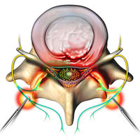 NON-SURGICAL TREATMENTS=Facet Injections and Rhizotomy