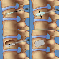 OTHER=Kyphoplasty