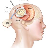 OTHER=Craniotomy