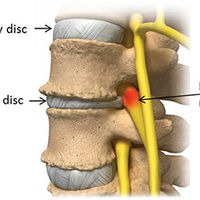 SPINAL DISORDERS=Degenerative Disc Disease