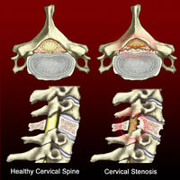 SPINAL DISORDERS=Spinal Stenosis